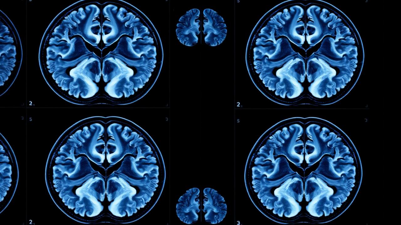 Protection neurologique